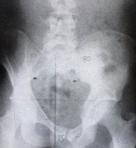 Røntgenbilde bekkenet, skjevt før behandling