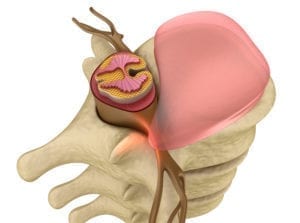 Anatomi ryggrad og ryggmarg med nerver som påvirkes av mellomvirvelskive