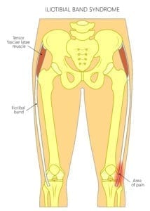 Anatomisk illustrasjonløpekne som viser smertens lokalisasjon