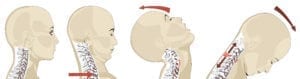 Illustrasjon whiplash
