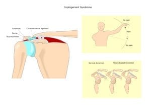 Bilde som viser anatomi skulder og smertebue/ painul arc