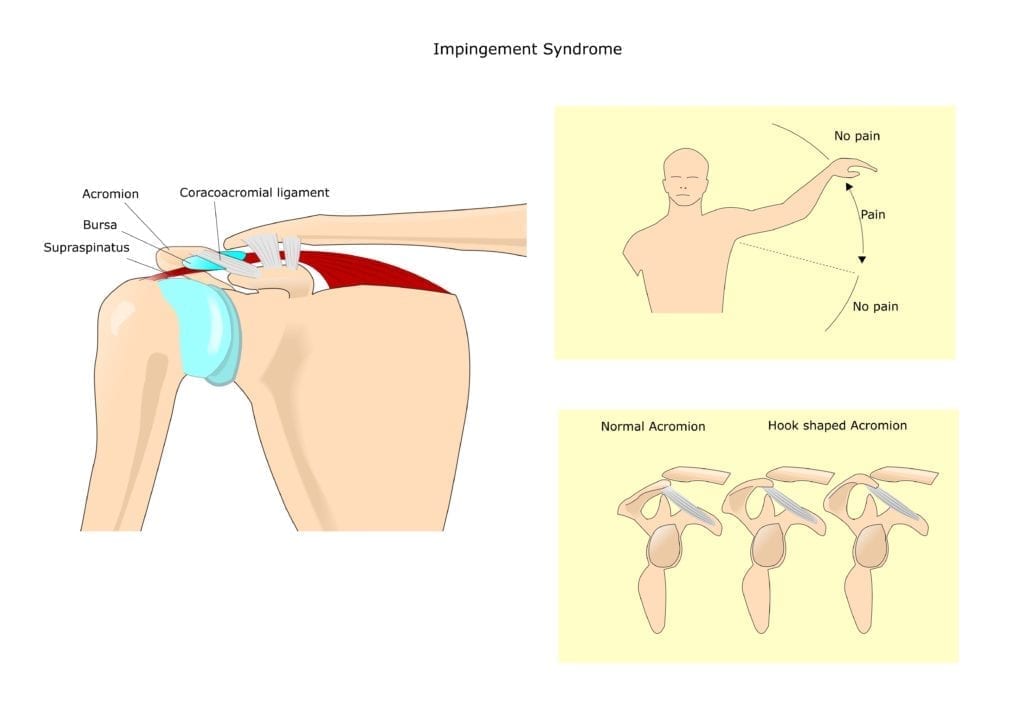 Anatomisk illustrasjon - Impingement med smertefull bue/ painful arc