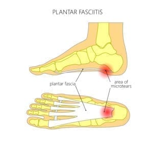 Illustrasjon plantar fasciitt